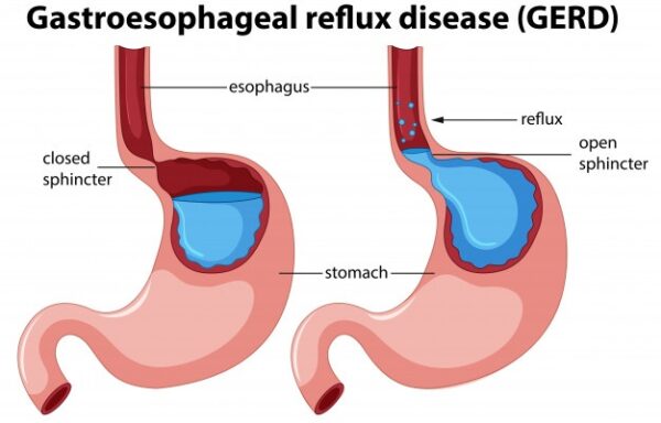 acid-reflux-sibo-the-methane-gas-producers-genefitletics